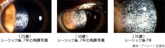 アベリーノ検査 アベリノ検査 の必要性について 角膜が薄いと診断されましたが 強度近視矯正へのチャレンジ をしました レーシック体験談