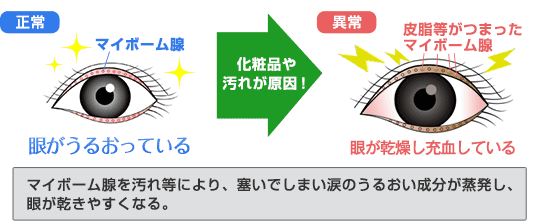 マイボーム腺を汚れ等により、塞いでしまい涙のうるおい成分が蒸発し、眼が乾きやすくなる。