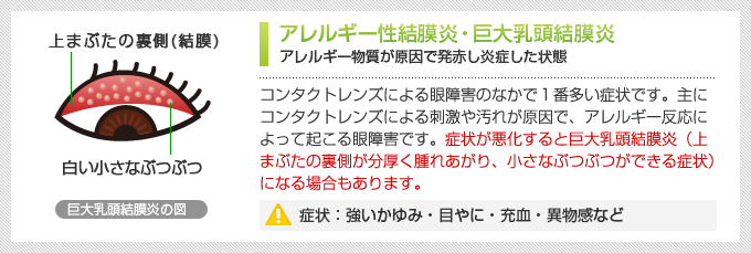 アレルギー性結膜炎・巨大乳頭結膜炎