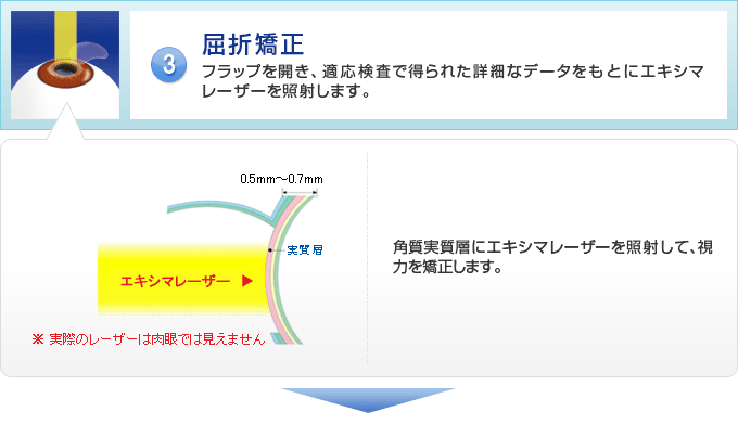 屈折矯正