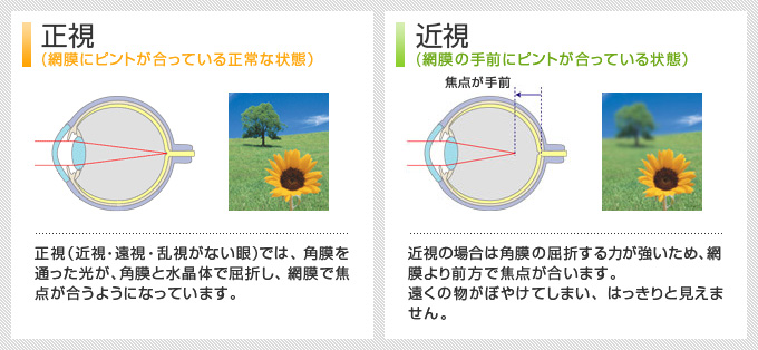 正視（網膜にピントが合っている正常な状態）近視（網膜の手前にピントが合っている状態）