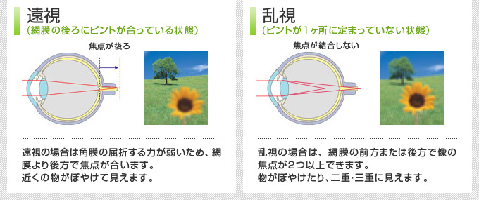 遠視（網膜の後ろにピントが合っている状態）乱視（ピントが一ヶ所に定まっていない状態）