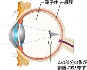 硝子体、網膜、この部分の影が網膜に映ります