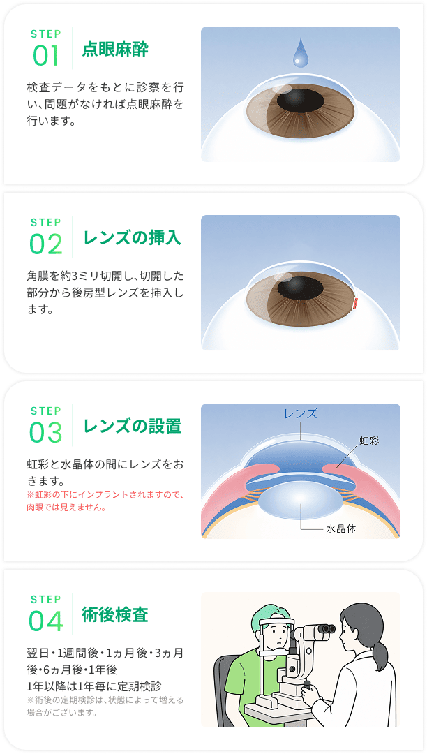 STEP01_点眼麻酔 STEP02_レンズの挿入 STEP03_レンズの設置 STEP04_術後検査