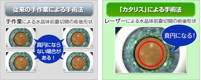 従来の手作業による手術法と最新機器「カタリス」による手術法