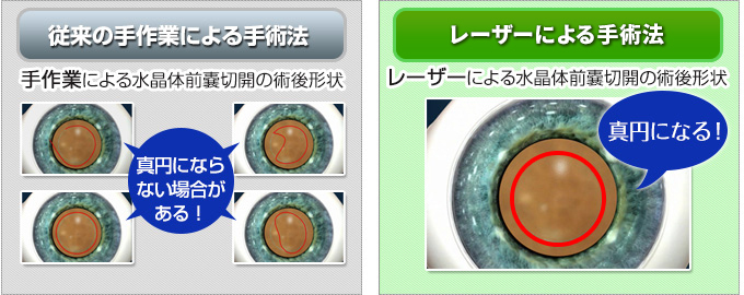 従来の手作業による手術法とレーザーによる手術法