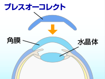 プレスオーコレクト