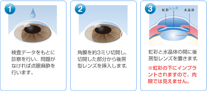 ?@検査データをもとに診察を行い、問題がなければ点眼麻酔を行います。?A角膜を約3ミリ切開し、切開した部分から後房型レンズを挿入します。?B虹彩と水晶体の間に後房型レンズを置きます。※虹彩の下にインプラントされますので、肉眼では見えません。