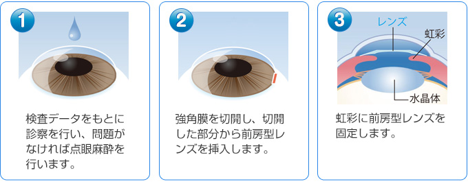 ?@検査データをもとに診察を行い、問題がなければ点眼麻酔を行います。?A強角膜を約3ミリ切開し、切開した部分から後房型レンズを挿入します。?B虹彩に前房型レンズを固定します。