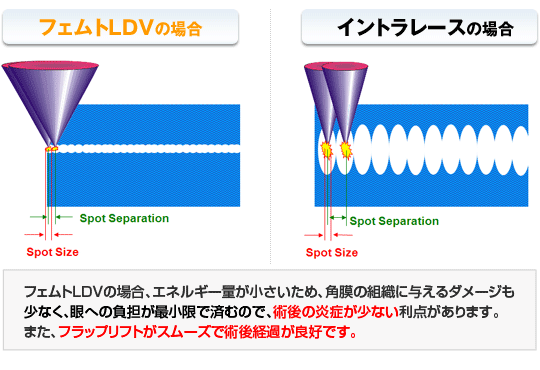 フェムトLDVの場合、エネルギー量が小さいため、角膜の組織に与えるダメージも少なく、眼への負担が最小限で済むので、術後炎症が少ない利点があります！また、フラップリフトがスムーズで術後経過が良好です！